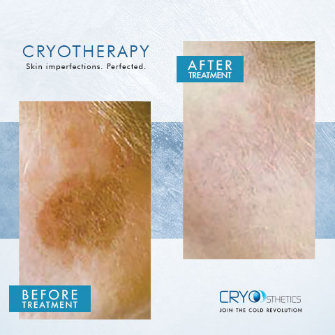 Cryotherapy treatments in Hampton