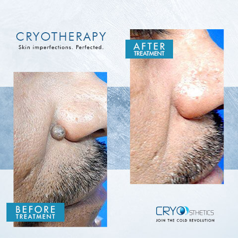 Cryotherapy treatments in Hampton