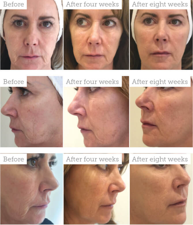 Skin rejuvenation with Profhilo, dermal fillers and more in Hampton from TW Aesthetics